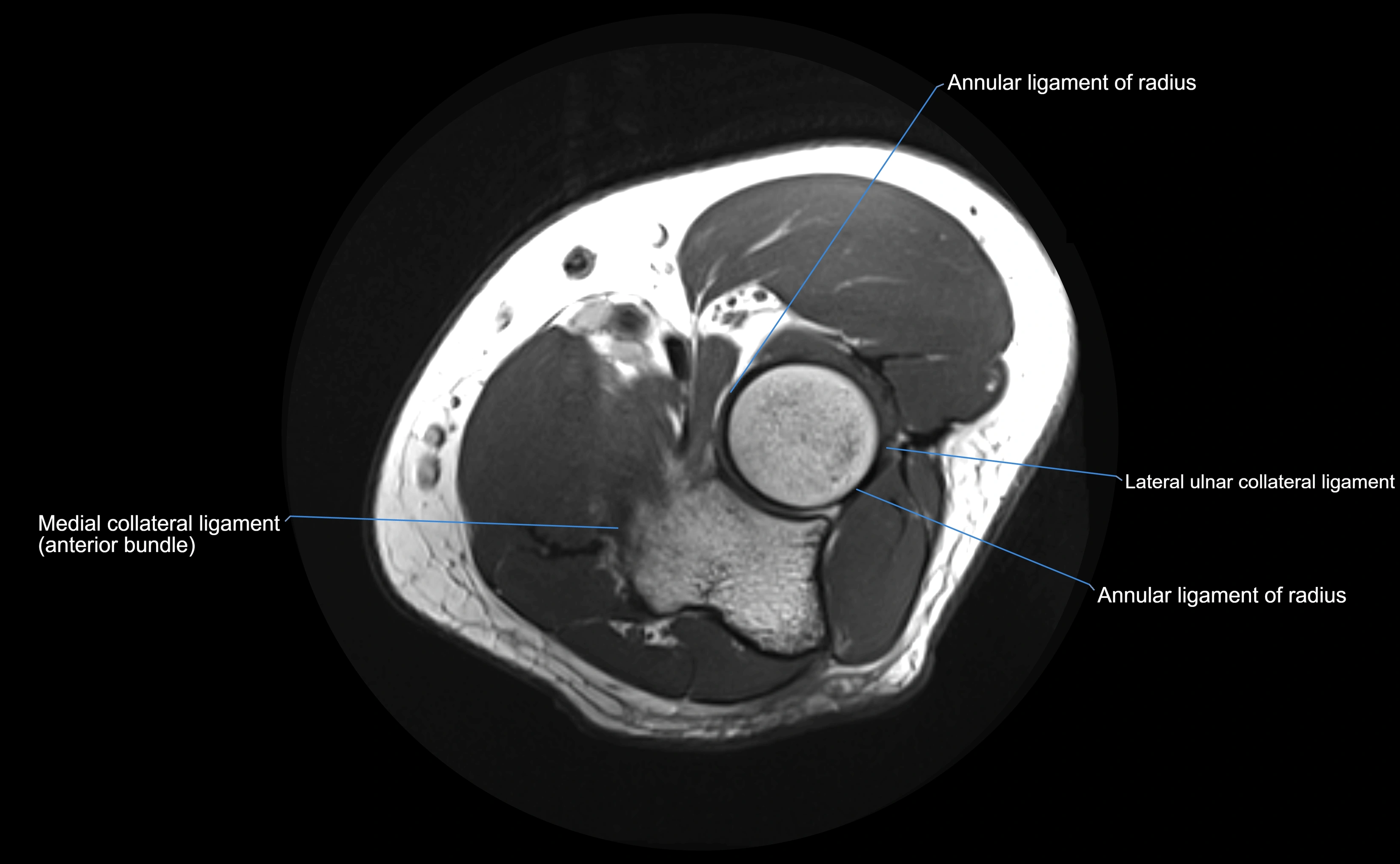 MRI elbow ligaments axial cross sectional anatomy 3T  radiology  image-img-00001-00018.webp